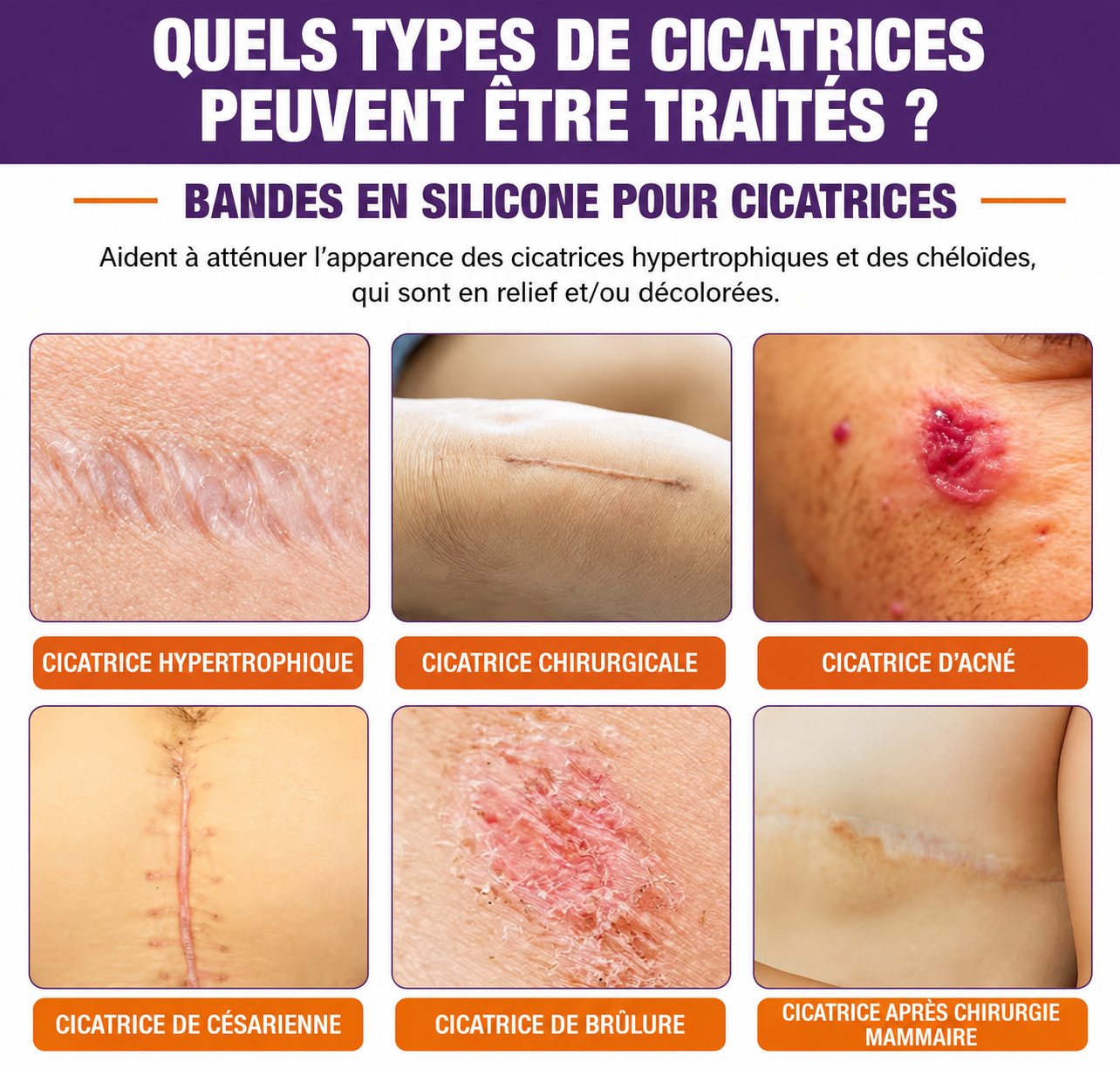 Bande Silicone Anti-Cicatrice